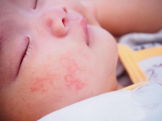 Ruam kulit pada bayi karena alergi